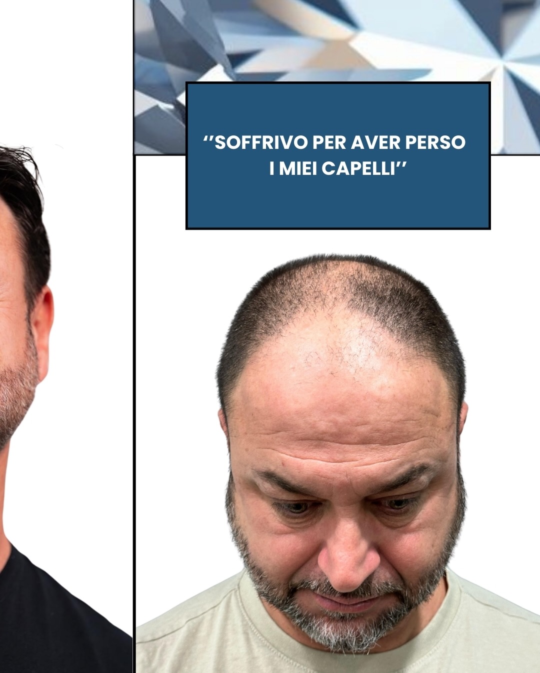 Prima del trapianto di capelli a Istanbul