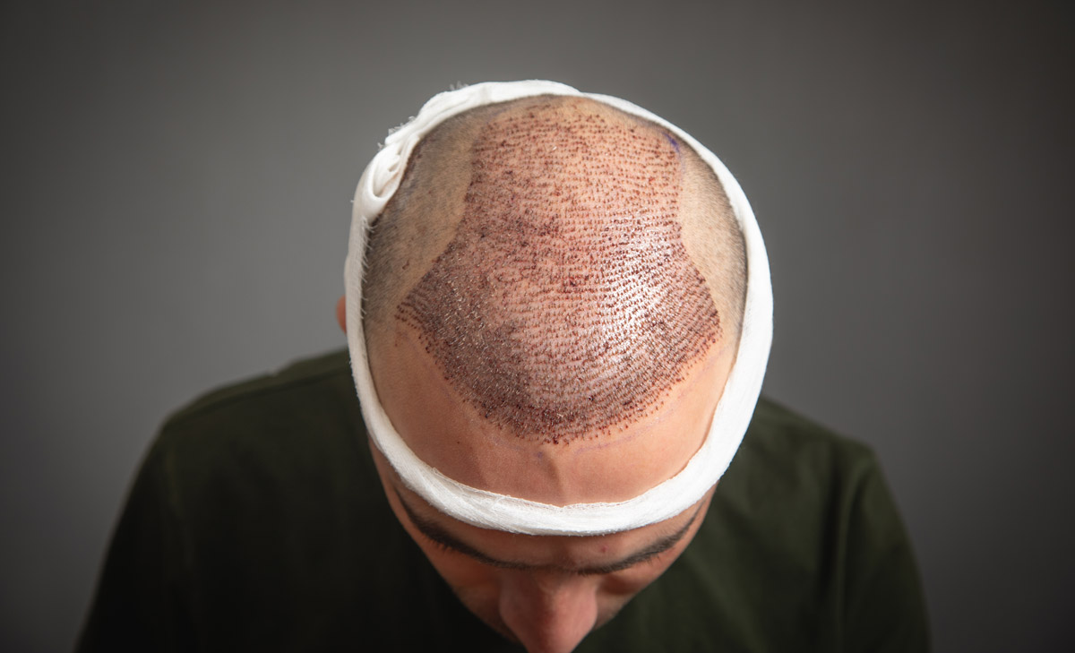 Trapianto di capelli