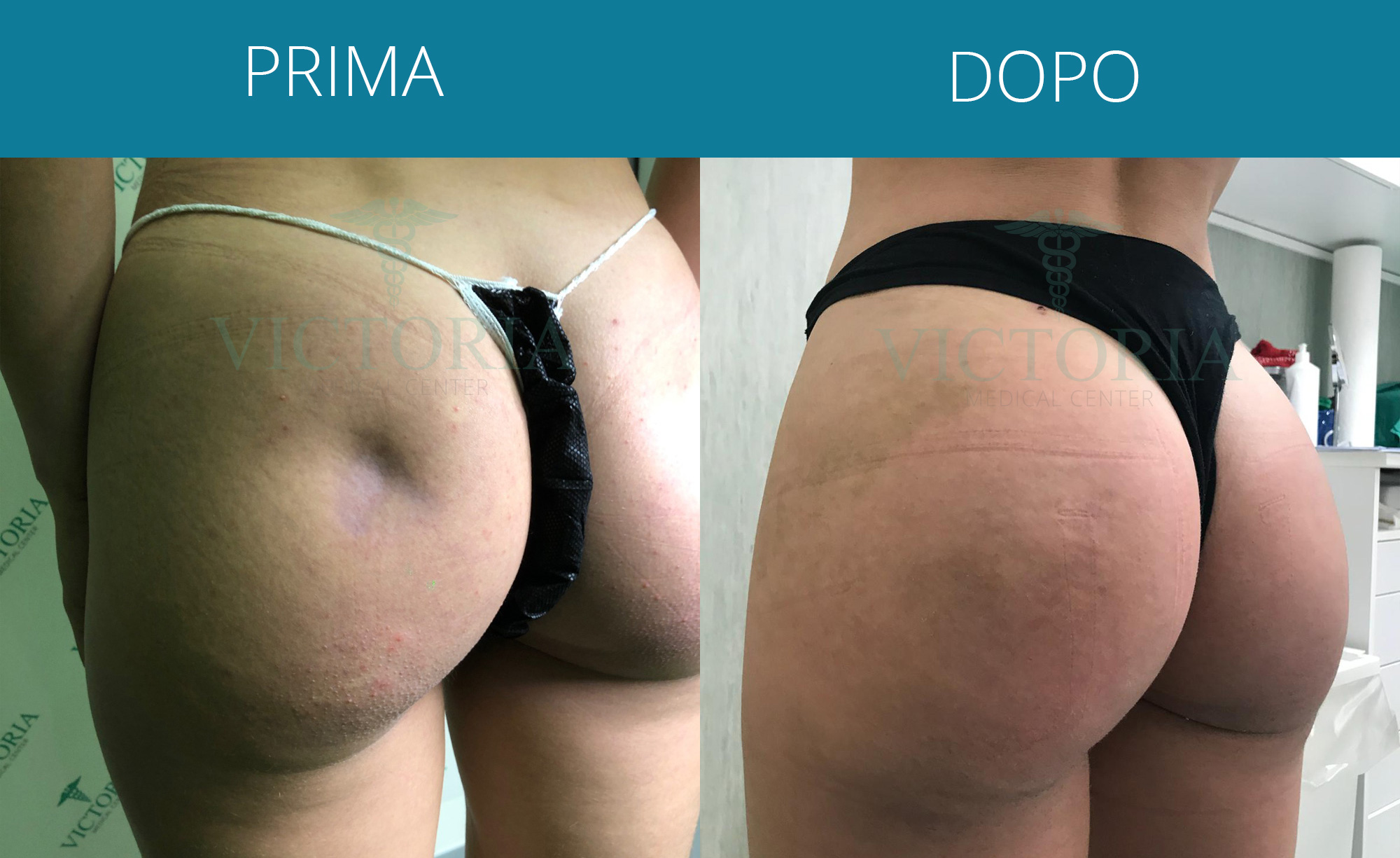 Liposuzione
