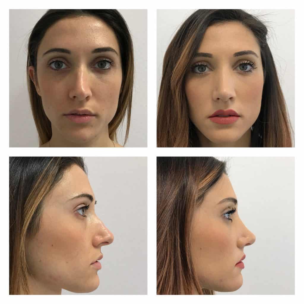 Risultato rinoplastica Istanbul - profilo e punta naturale