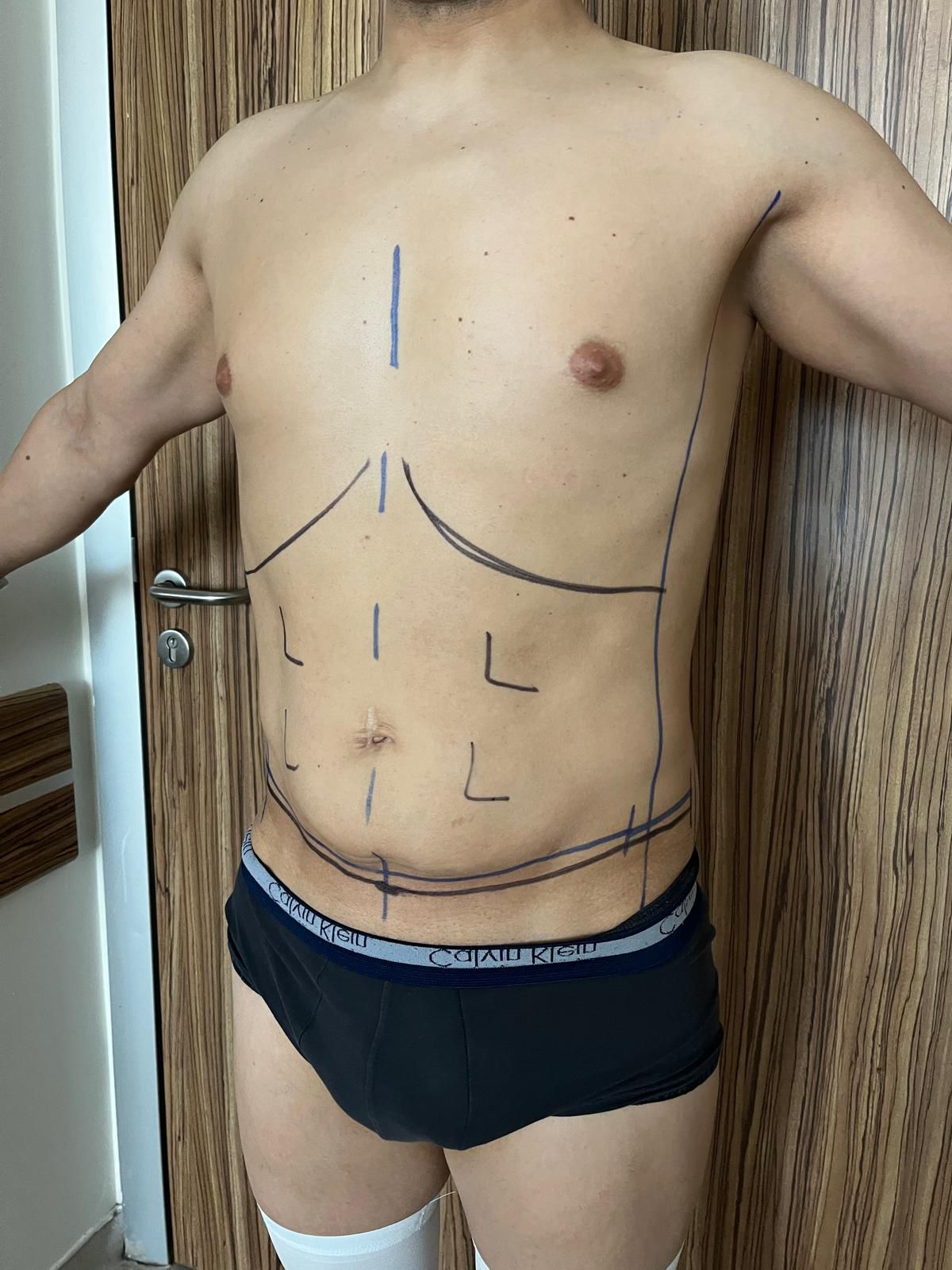 Prima liposuzione e addominoplastica in Turchia 1