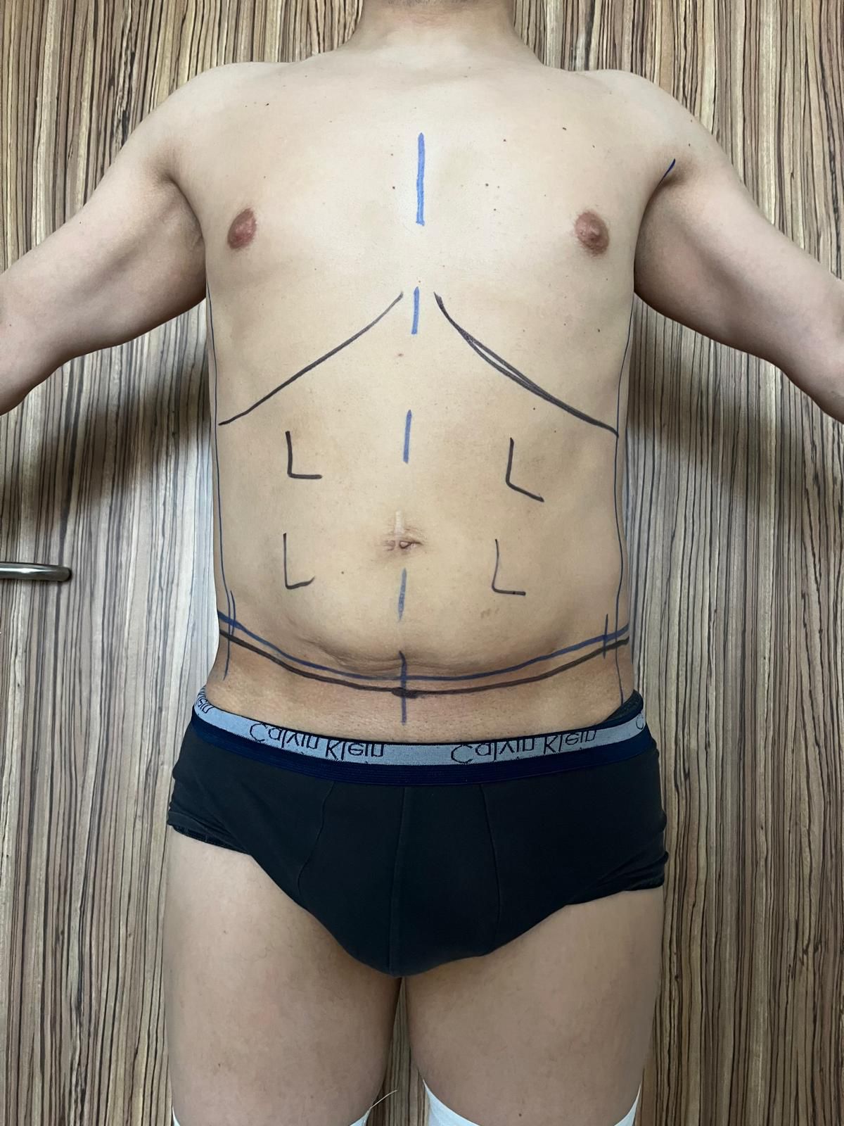 Prima liposuzione e addominoplastica in Turchia 2