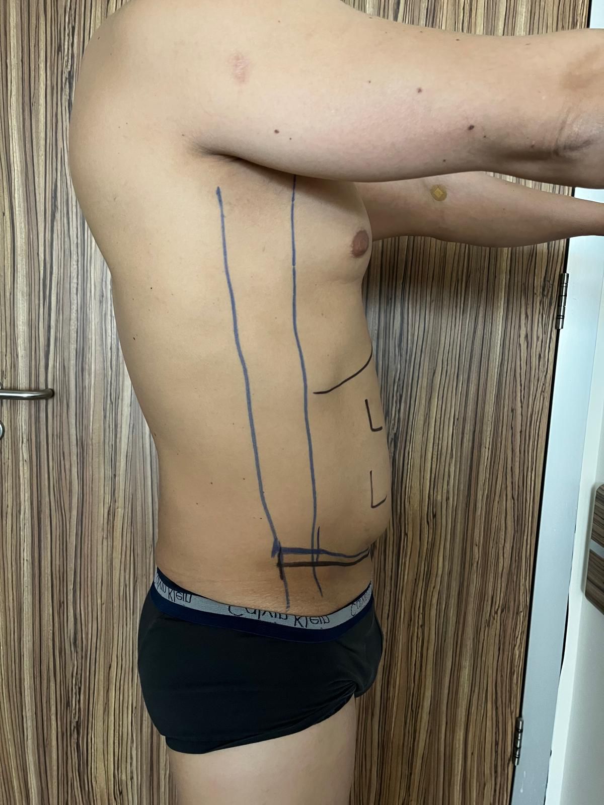 Prima liposuzione e addominoplastica in Turchia 3