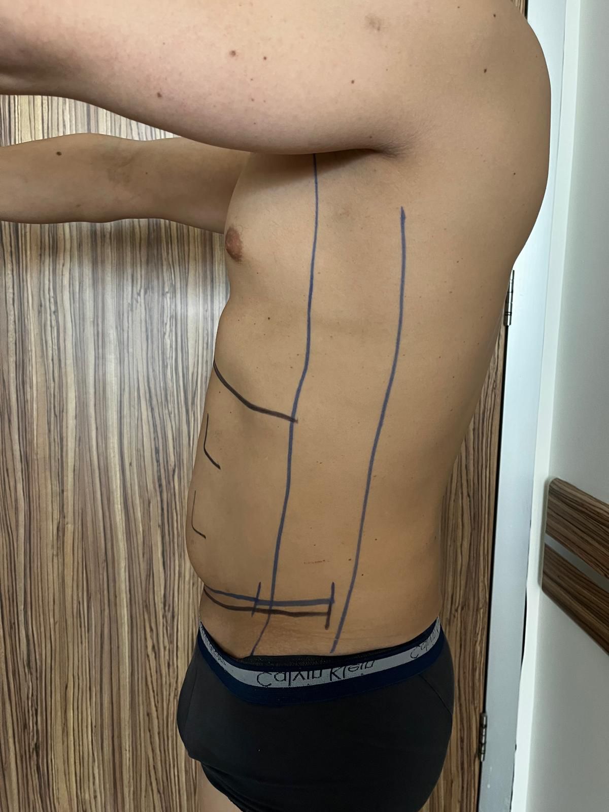 Prima liposuzione e addominoplastica in Turchia 4