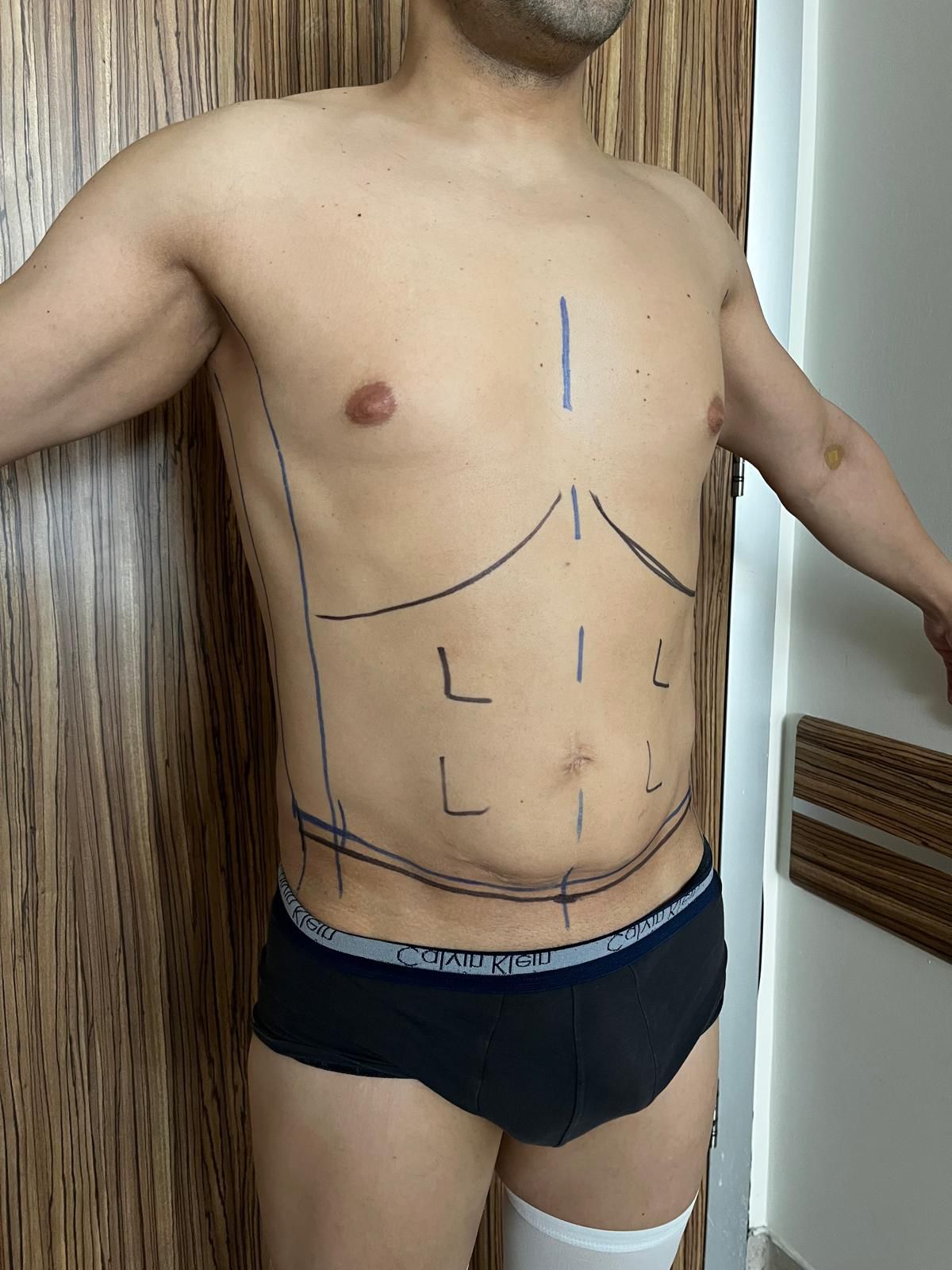 Prima liposuzione e addominoplastica in Turchia 6