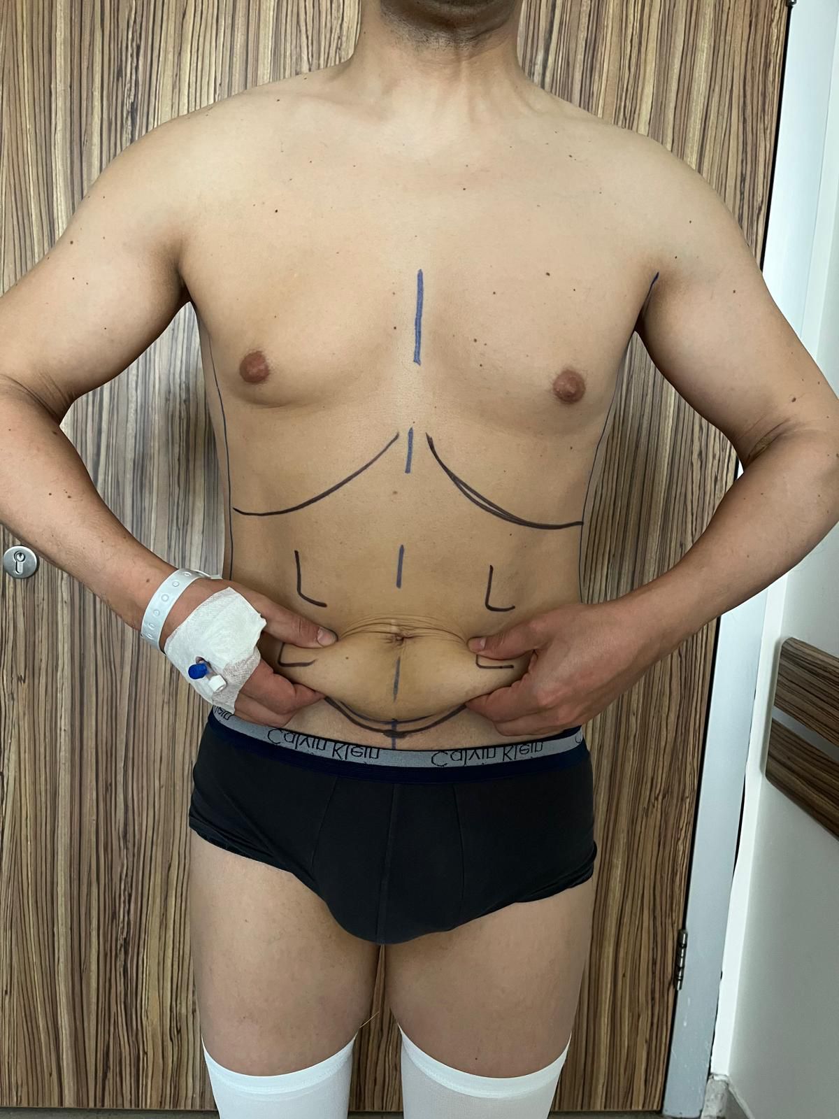 Prima liposuzione e addominoplastica in Turchia 7