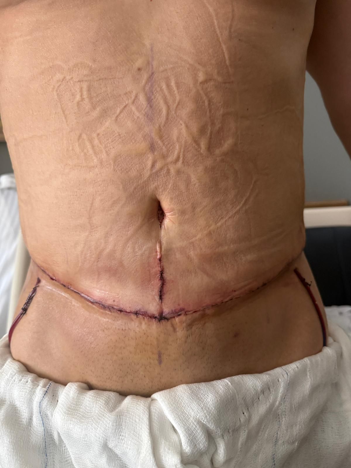 Lipoaddominoplastica in Turchia durante la medicazione finale dopo intervento addominale