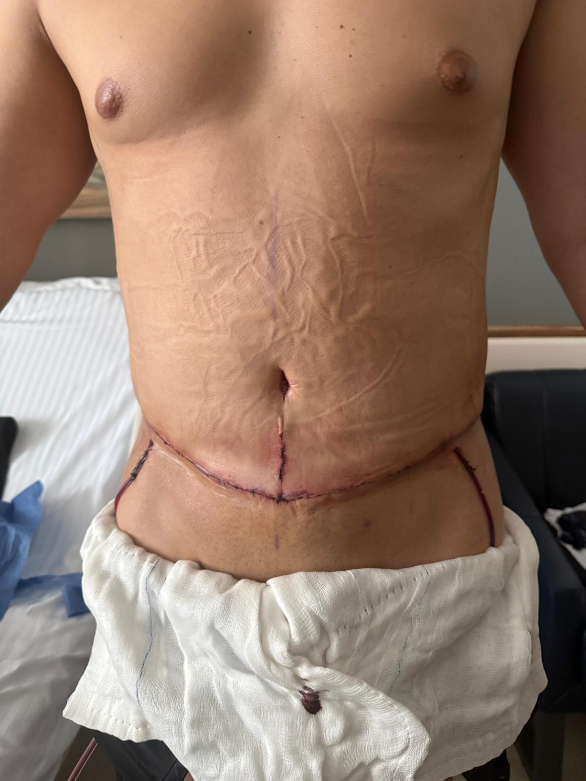 Lipoaddominoplastica in Turchia nella fase finale con medicazione e assistenza post operatoria
