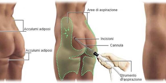 Liposuzione a Istanbul in Turchia - tecniche di liposuzione