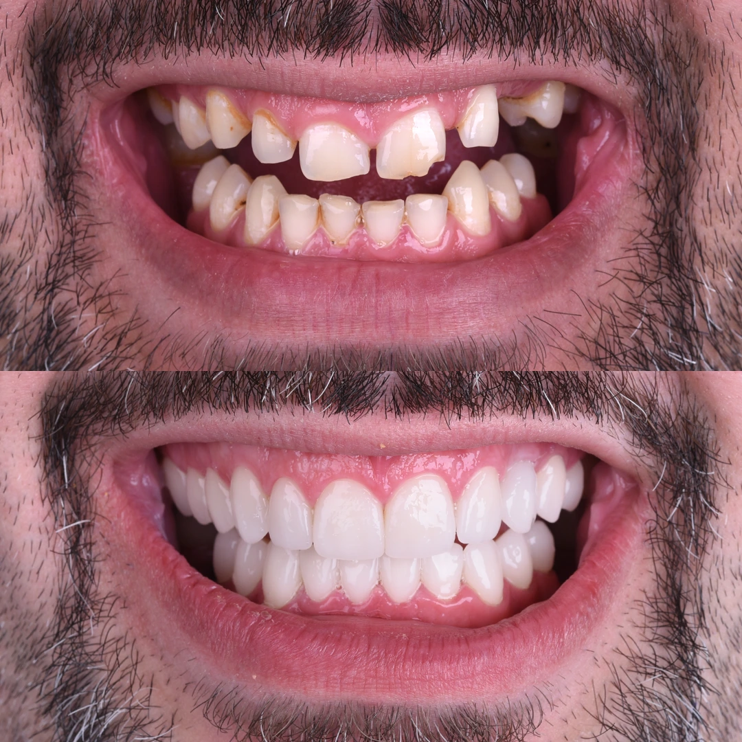 Denti - Hollywood Smile